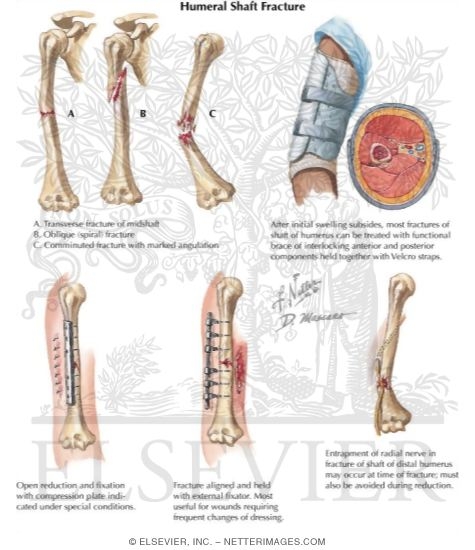 Watermarked preview of labeled image: Humeral Shaft Fractures
