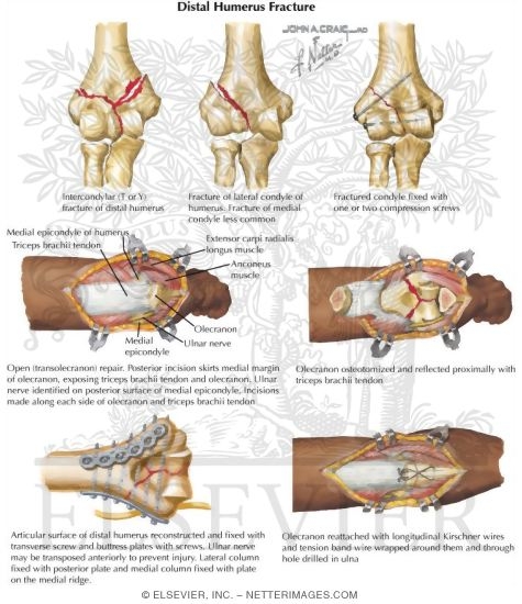 Distal Humerus Fractures