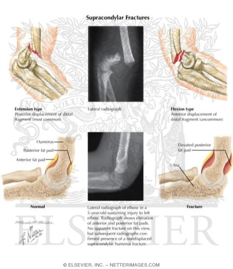 Watermarked preview of labeled image: Supracondylar Fracture