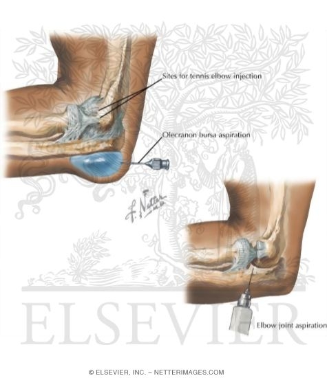 Watermarked preview of labeled image: Injections and Aspirations at the Elbow