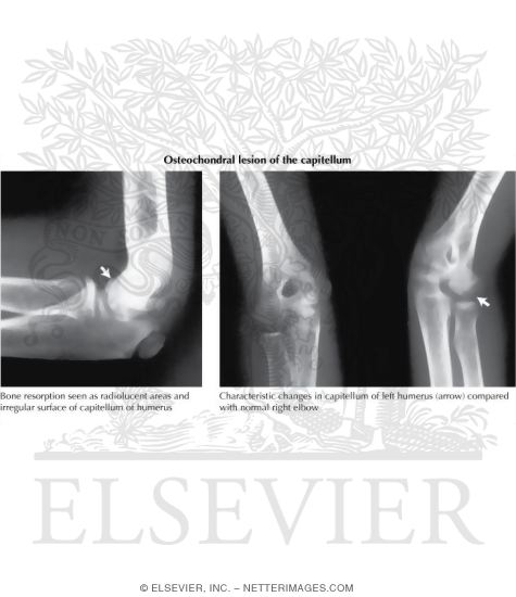 Watermarked preview of labeled image: Osteochondral Lesion of the Capitellum