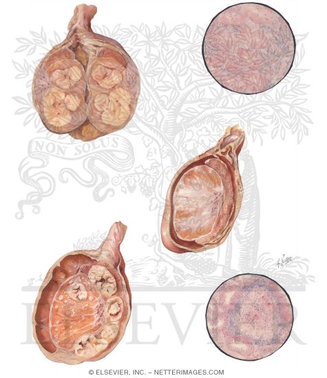 Granulomata of the Testicle