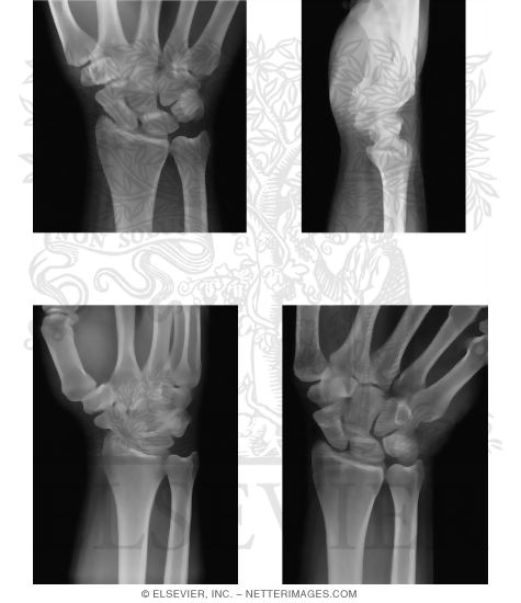Watermarked preview of unlabeled image: Radiology of the Forearm