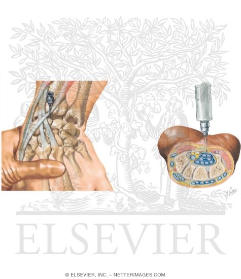 Watermarked preview of unlabeled image: Minor Procedures of the Forearm