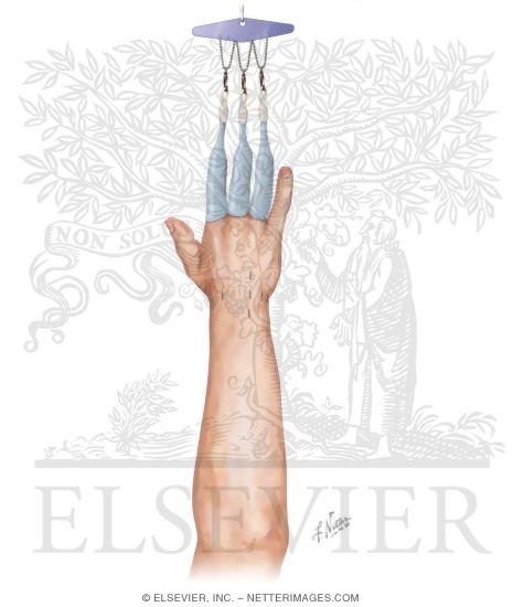 Watermarked preview of unlabeled image: Surgical Approaches to the Forearm