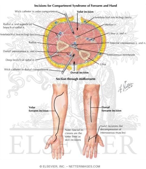 Watermarked preview of labeled image: Incisions for Compartment Syndrome of Forearm and Hand
Surgical Approaches
