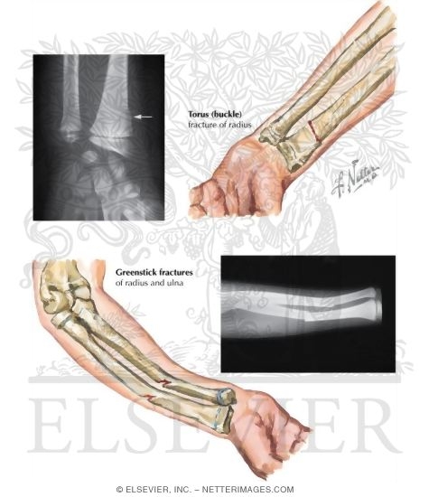 Watermarked preview of labeled image: Fracture of the Forearm