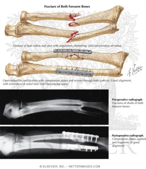 Watermarked preview of labeled image: Trauma of the Forearm