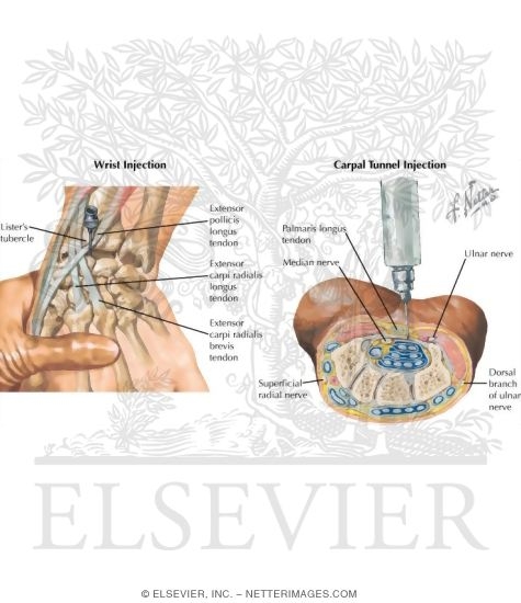 Watermarked preview of labeled image: Minor Procedures of the Forearm