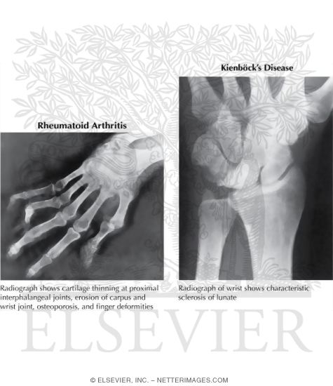 Watermarked preview of labeled image: Disorders of the Forearm