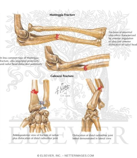 Monteggia Fracture
Galeazzi Fracture