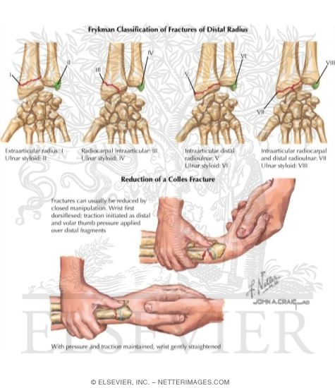 Colles Fracture Classification Colles Fracture Classification