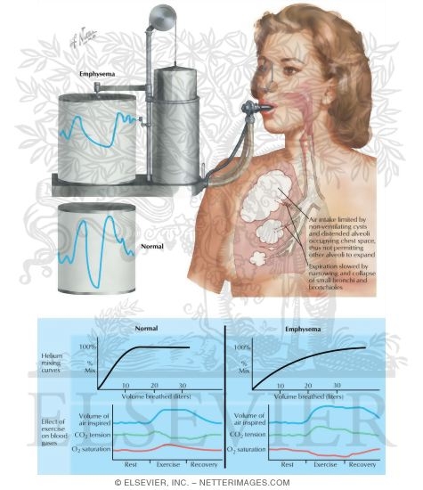 Watermarked preview of labeled image: Physiologic Testing for Emphysema