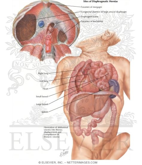 Diaphragmatic Hernia