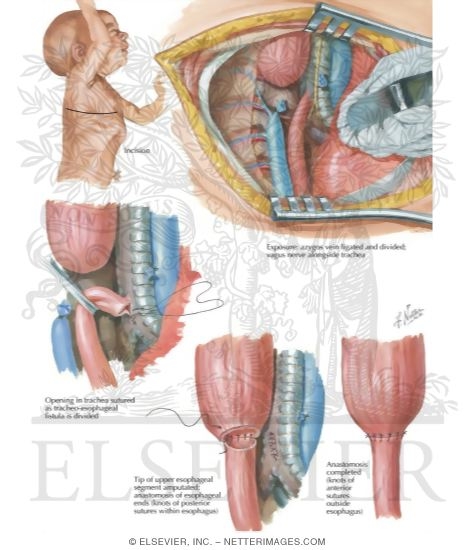 Watermarked preview of labeled image: Transpleural Approach To Atresia Of Esophagus