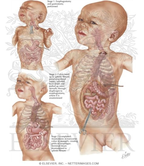 Watermarked preview of labeled image: Transpleural Approach To Atresia Of Esophagus