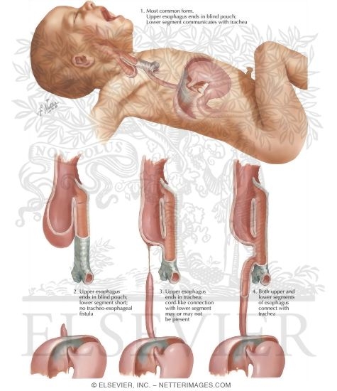 Watermarked preview of labeled image: Various Forms Of Atresia Of Esophagus