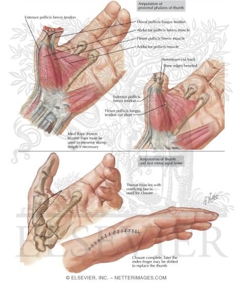 Amputations Of Upper Extremity