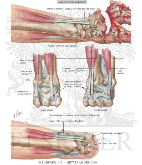Amputations Of Upper Extremity