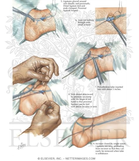 Watermarked preview of labeled image: Catheterization Of Saphenous - View II