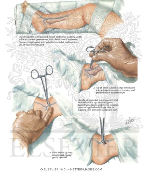 Watermarked preview of labeled image: Catheterization Of Saphenous - View I