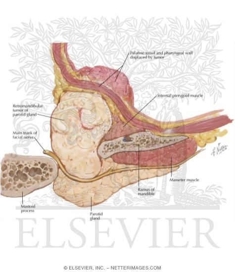 Surgical Removal Of Parotid Tumors