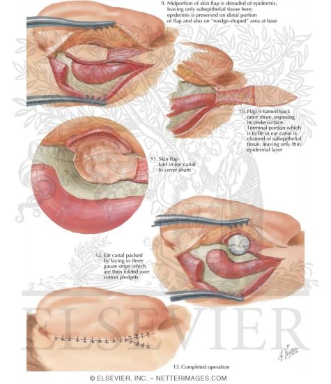 Watermarked preview of labeled image: Tympanoplasty And Mastoidectomy