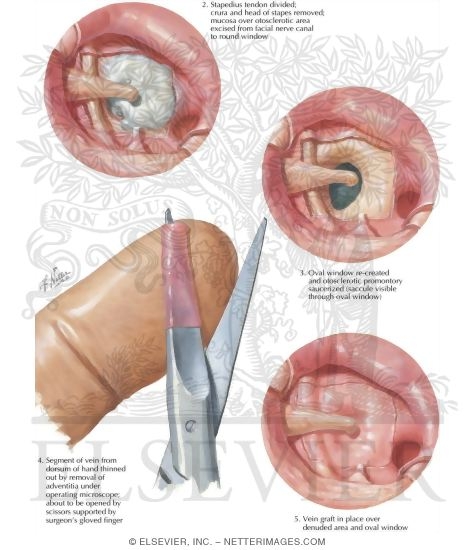 Watermarked preview of labeled image: Otosclerosis - Vein Graft
