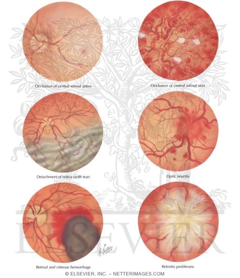 Watermarked preview of labeled image: Retinal And Optic Nerve Lesions