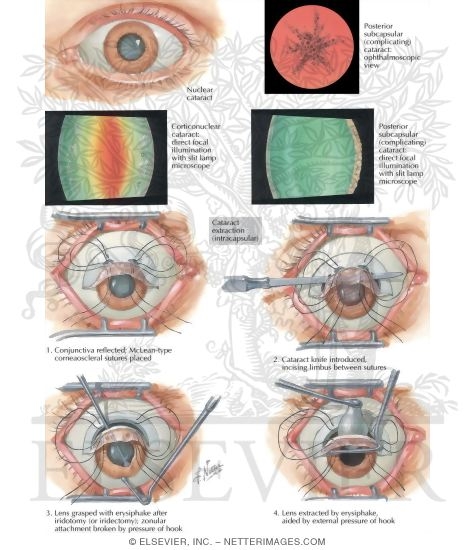 Watermarked preview of labeled image: Cataract