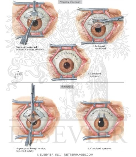 Peripheral Iridectomy, Iridencleisis