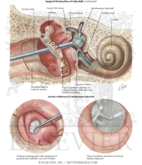 Watermarked preview of labeled image: Surgical Destruction of Labyrinth