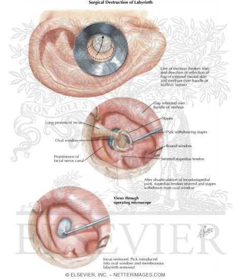 Watermarked preview of labeled image: Surgical Destruction of Labyrinth