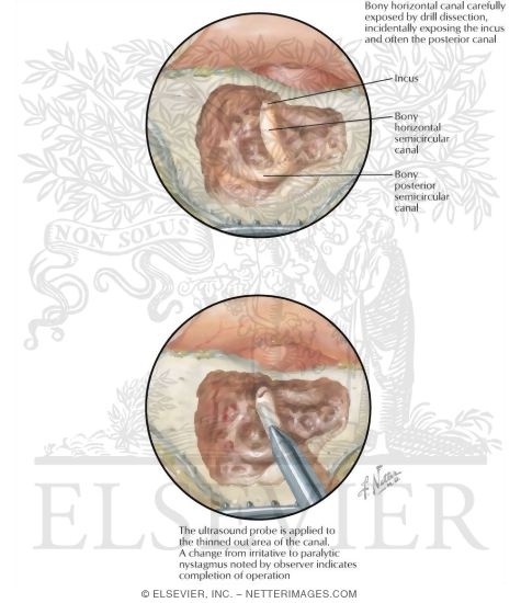 Watermarked preview of labeled image: Ultrasonic Destruction of Vestibular Labyrinth