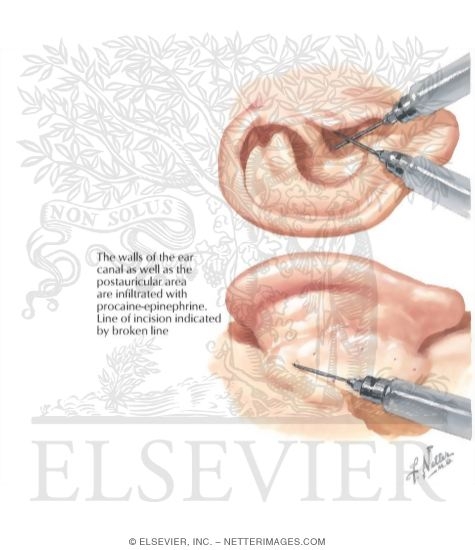 Watermarked preview of labeled image: Ultrasonic Destruction of Vestibular Labyrinth