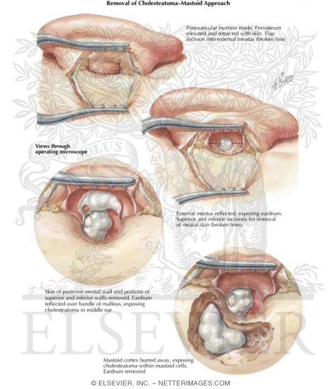 Mastoid Approach for Removal of Cholesteatoma