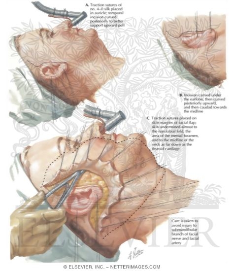 rhytidectomy