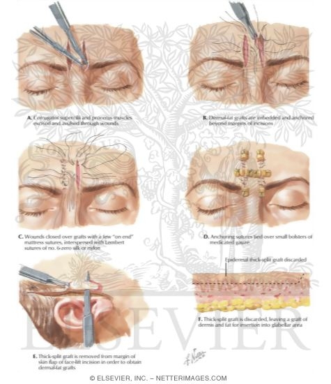 Watermarked preview of labeled image: Removal of Frown Furrows