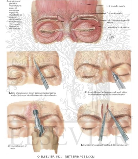 Watermarked preview of labeled image: Removal of Frown Furrows