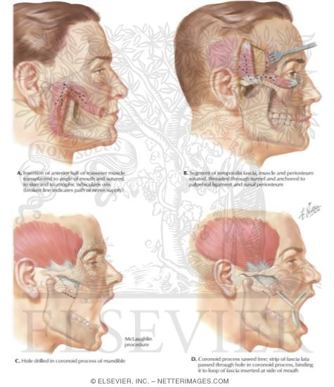 Watermarked preview of labeled image: Muscle Plastic Operations for Facial Nerve Paralysis