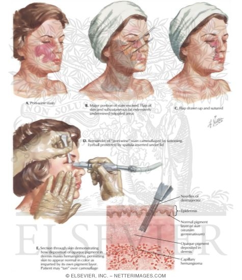 Watermarked preview of labeled image: Removal of Port-Wine Stain (Hemangioma)