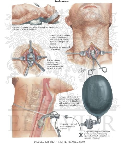Watermarked preview of labeled image: Insertion of Cuff-Type Tracheostomy Tube