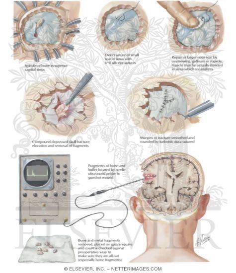 Watermarked preview of labeled image: Additional Indications for Early Operations: Sinus Tears, Compound Depressed Fractures, and Penetration Injuries