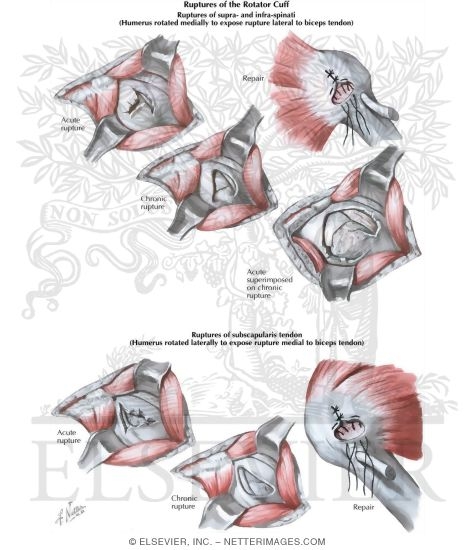 Watermarked preview of labeled image: Ruptures Of The Rotator Cuff