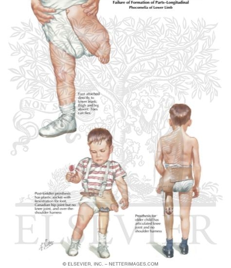 Watermarked preview of labeled image: Longitudinal Arrest of the Lower Limb: Phocomelic Type