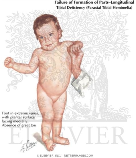 Watermarked preview of labeled image: Longitudinal Arrest: Tibial Ray Deficiency