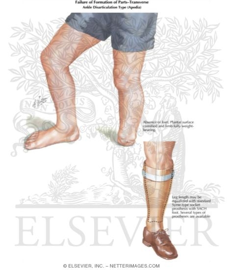 Transverse Arrest of the Ankle: Disarticulation Type