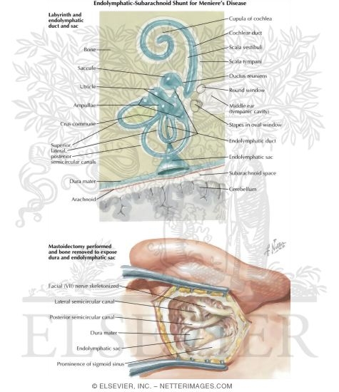 Watermarked preview of labeled image: Endolymphatic: Subarachnoid Shunt for Meniere's Disease