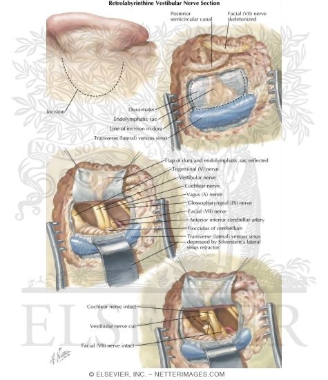 Vestibular Nerve Section