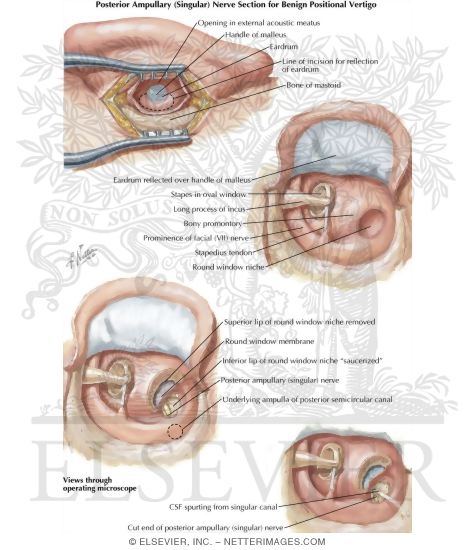 Watermarked preview of labeled image: Posterior Ampullary (singular) Nerve Section for Benign Positional Vertigo